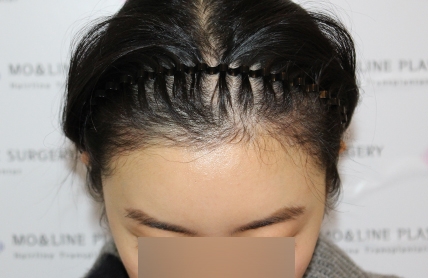 치료후기 이미지